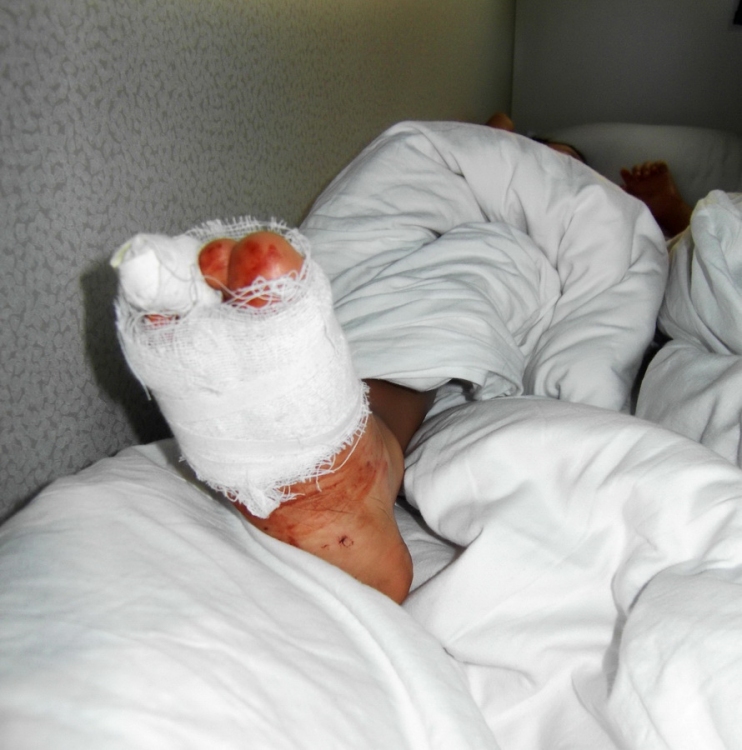 图为受伤男孩脚趾被包扎后安稳地睡着了.