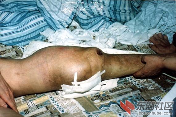 血友病患者:大腿肌肉长期血肿,穿孔;后被迫截肢;2003年6血因血友病
