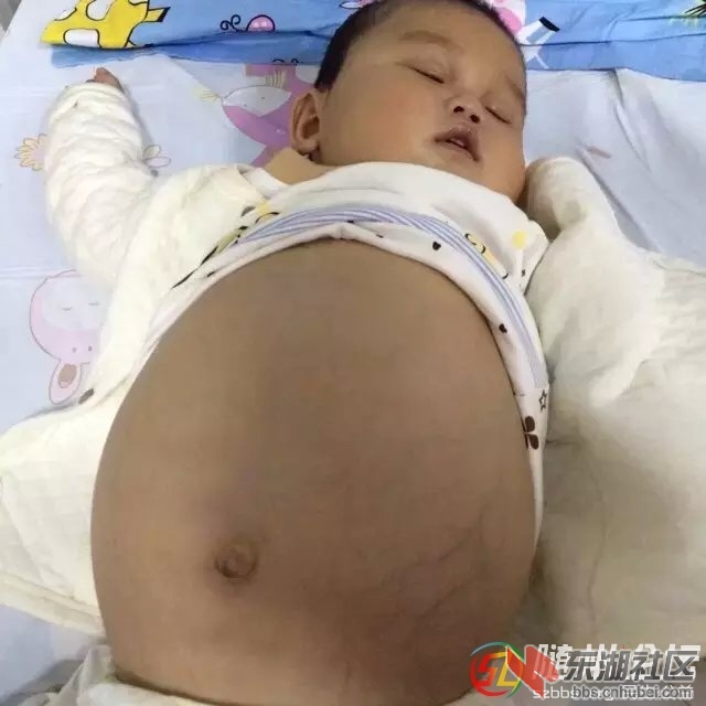 孩子已经肝硬化腹水